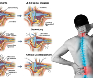 L5 S1 Spine Aavya Health